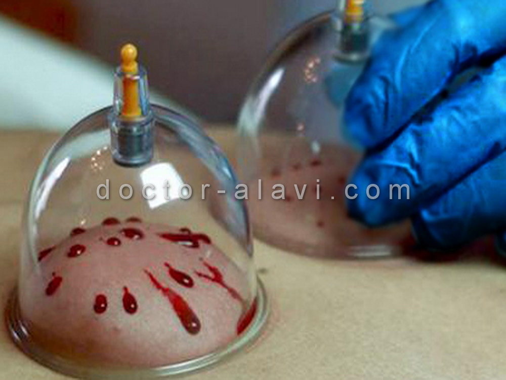 هزینه حجامت رسالت 