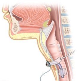 Silicone Tracheostomy Tube