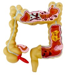 Colon Disease Anatomical Model